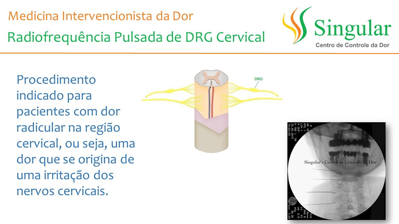 RF DRG cervical